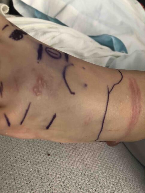 Niña en Texas se recupera tras mordida de cascabel culebratxbrazo.jpg