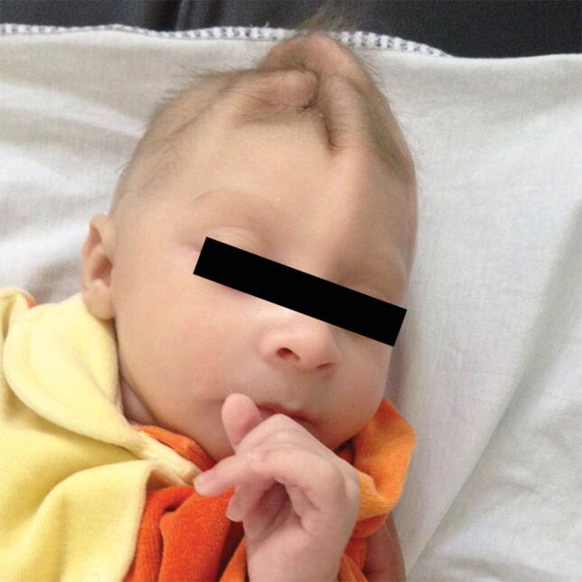 El virus del zika y el cerebro del bebé de una madre de 20 años 7g.jpeg