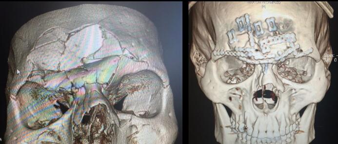 Evangelista 'Cyborg' Santos fue al quirófano 11 días después de la fract...